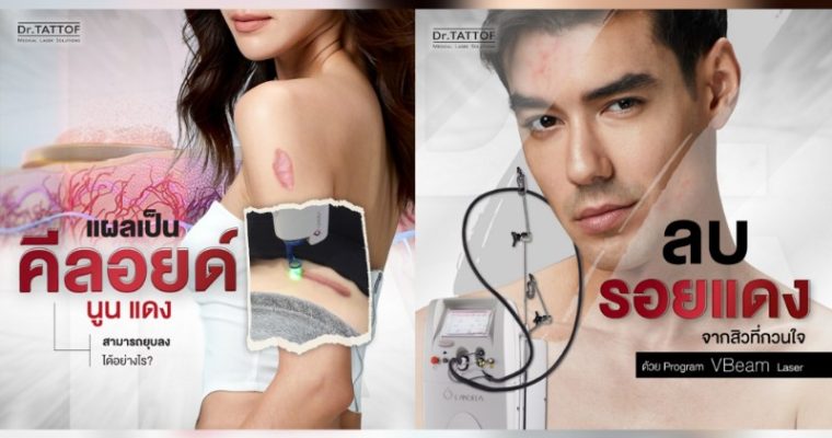 Dr.TATTOF ยกระดับการรักษาผิวด้วยเลเซอร์โปรแกรม VBeam เลเซอร์รักษารอยแดง สิวอักเสบ ปานแดง และคีลอยด์อย่างมีประสิทธิภาพ